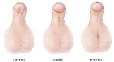 Diagram showing hypospadias