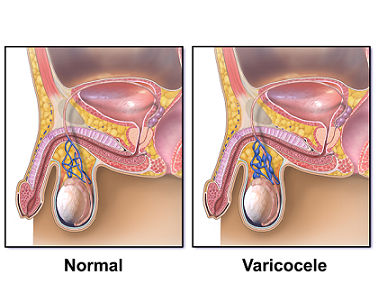Diagram of a varicocele, or enlarged vein in the scrotum